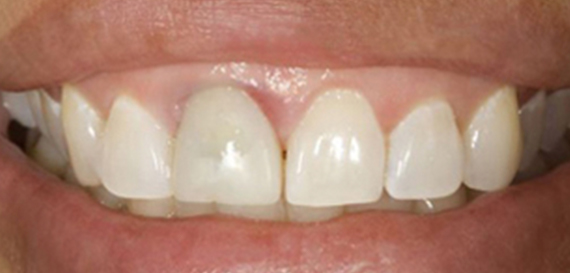 Replacement Crown to all Porcelain