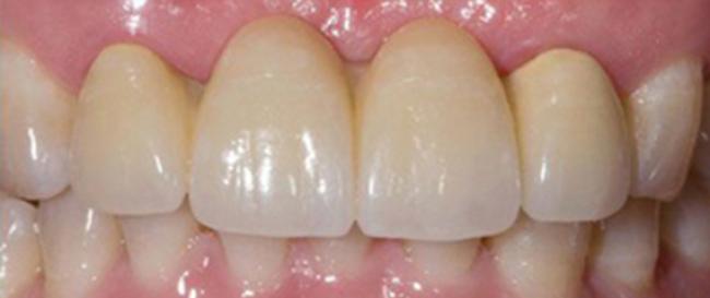 Missing Teeth Replaced by Bridge