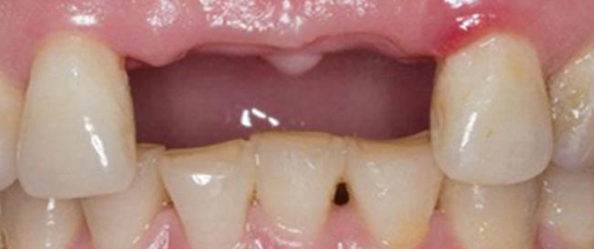 Missing Teeth Replaced by Bridge